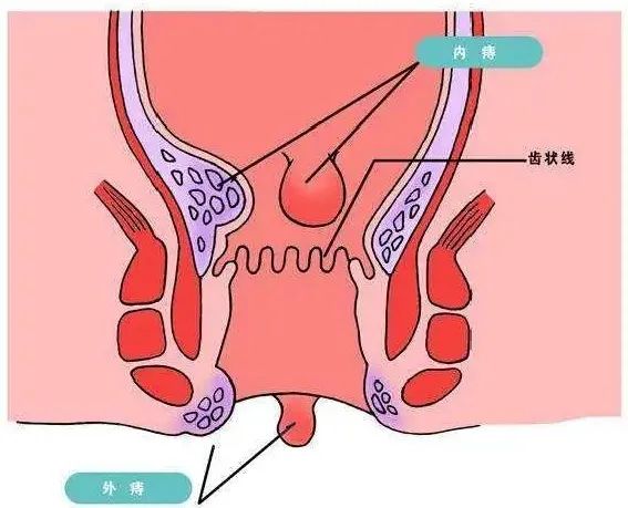 <strong>九江治疗痔疮，十男九痔，十女十痔，治还是不治？怕做痔疮手术？内镜微创手术了解一下！</strong>